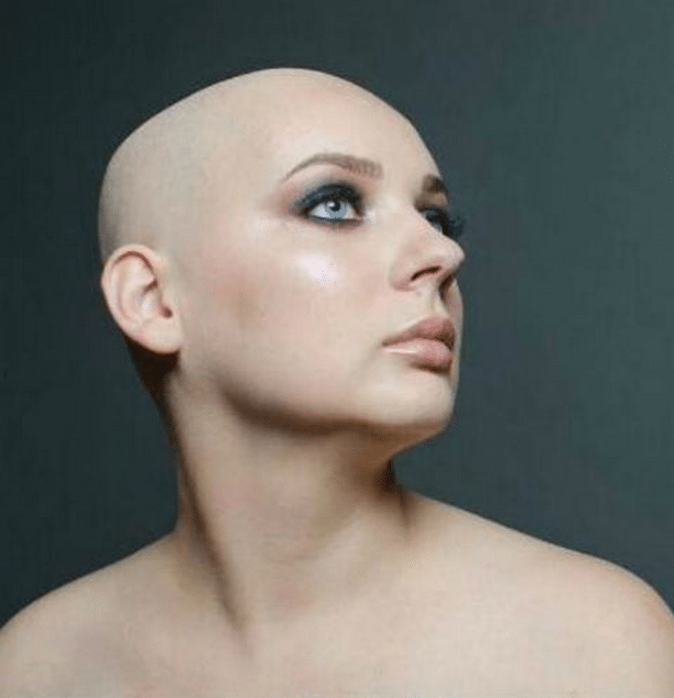 Скончалась 24-летняя Виталина Афанасова, которая стала моделью из-за рака