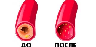 Эффективный метод очищения крови и сосудов: рецепт уникального средства под названием «7 стаканов»!
