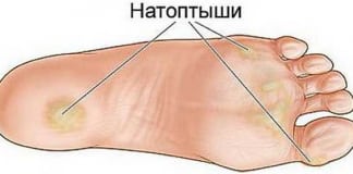 Простые рецепты для устранения натоптышей, трещин, мозолей, сосудистой сетки и варикоза!