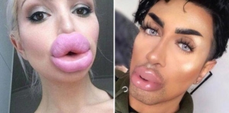 25 людей, которые решили увеличить губы, но что-то пошло не так и получился полный ужас