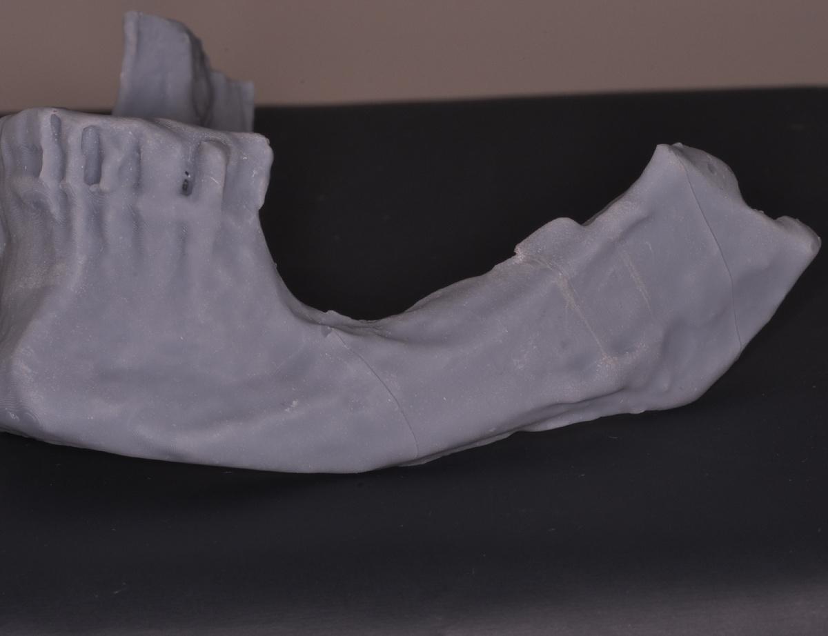 Дефект костной ткани нижней челюсти