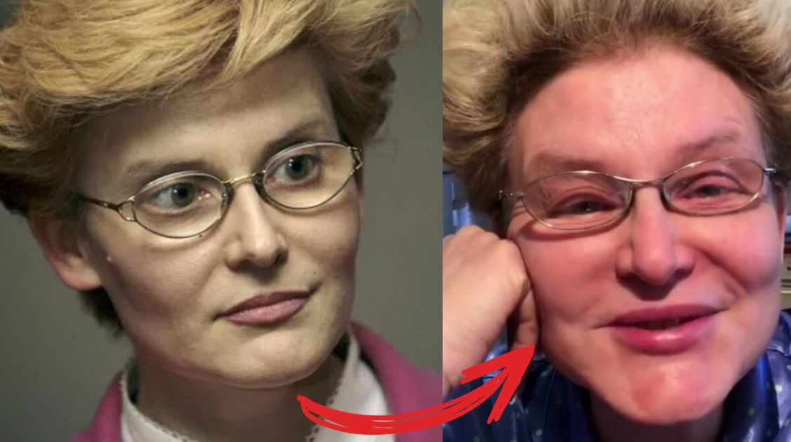 Узнали только по голосу. Какая болезнь оставила Елену Малышеву без лица?