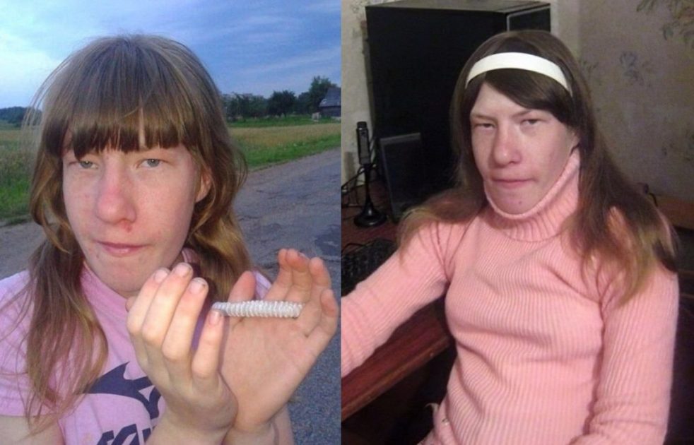 Над ней смеялись и называли Квазимодо