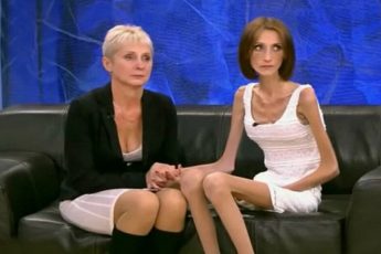 Как сейчас выглядит Анна Егрчукова, которая весила 26 кг при росте 168 см