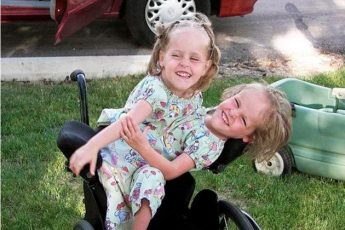 Сиамских близнецов разделили, когда им было 4 года. Сейчас девочкам уже по 20 лет. Как они выглядят