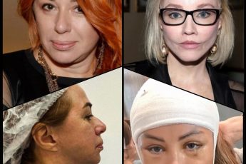 Подтяжка Зудиной, подбородок Апиной, новый "змей" Лепса и банки Киркорова|звездная пластика 2024 года