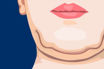 Брыли на лице: почему они появляются, и как убрать «бульдожьи щечки»? Обзор методов